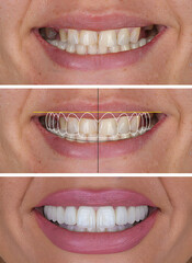Smile design treatment and smile makeover with porcelain laminates to restore teeth and dental...