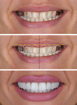 Smile design treatment and smile makeover with porcelain laminates to restore teeth and dental alignment in dental aesthetic dentistry. Dental before after with computer aided dental design.
