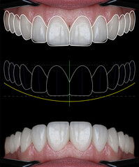 In aesthetic dentistry, digital smile design involves creating an enhanced smile using laminate...