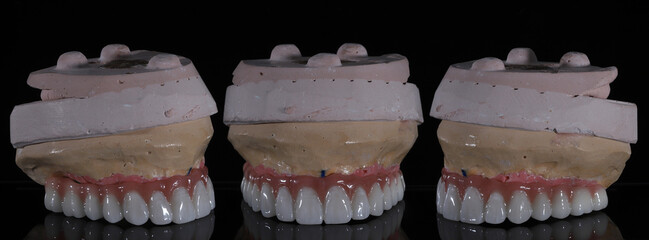 Full-arch porcelain implant-supported dental prosthesis for edentulous jaws with All-on-X and...