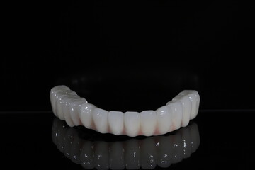 Full-arch porcelain implant-supported dental prosthesis for edentulous jaws with All-on-X and All-on-4 treatment procedure using dental implant surgery.