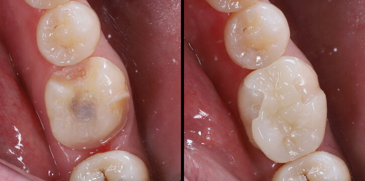 Digital production porcelain dental inlay and onlay used for enamel restoration in dental dentistry.

