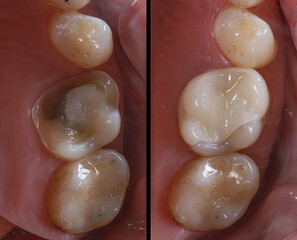 Digital production porcelain dental inlay and onlay used for enamel restoration in dental dentistry.   © UniqDream
