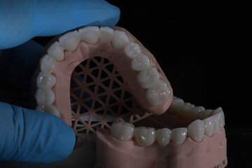 3D-printed jaw model and full-mouth zirconium porcelain crowns. Computer-assisted smile design treatment. dental before after.  © UniqDream