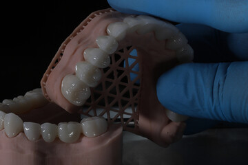 3D-printed jaw model and full-mouth zirconium porcelain crowns. Computer-assisted smile design treatment. dental before after.  © UniqDream