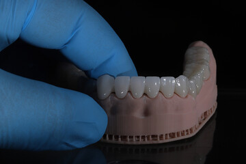 3D-printed jaw model and full-mouth zirconium porcelain crowns. Computer-assisted smile design treatment. dental before after.  © UniqDream