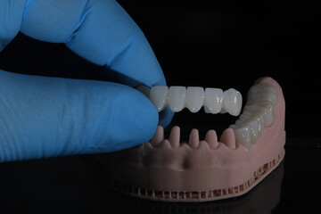 3D-printed jaw model and full-mouth zirconium porcelain crowns. Computer-assisted smile design treatment. dental before after.  © UniqDream