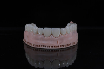 3D-printed jaw model and full-mouth zirconium porcelain crowns. Computer-assisted smile design treatment. dental before after.
