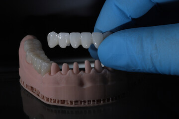 3D-printed jaw model and full-mouth zirconium porcelain crowns. Computer-assisted smile design treatment. dental before after.  © UniqDream