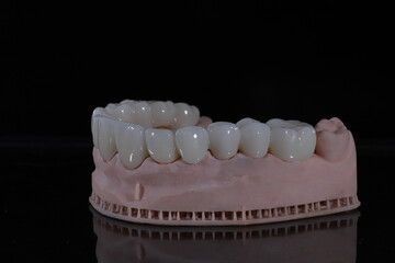 3D-printed jaw model and full-mouth zirconium porcelain crowns. Computer-assisted smile design treatment. dental before after.  © UniqDream
