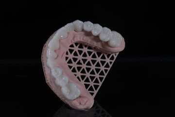 3D-printed jaw model and full-mouth zirconium porcelain crowns. Computer-assisted smile design treatment. dental before after.  © UniqDream