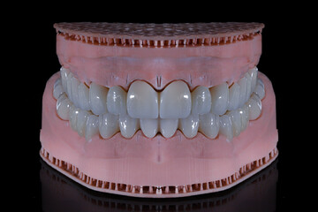 3D-printed jaw model and full-mouth zirconium porcelain crowns. Computer-assisted smile design treatment. dental before after.  © UniqDream