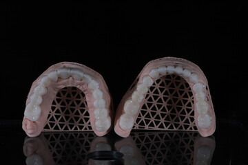 3D-printed jaw model and full-mouth zirconium porcelain crowns. Computer-assisted smile design treatment. dental before after.  © UniqDream