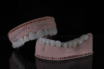 3D-printed jaw model and full-mouth zirconium porcelain crowns. Computer-assisted smile design treatment. dental before after.  © UniqDream