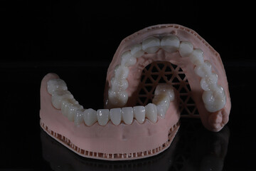 3D-printed jaw model and full-mouth zirconium porcelain crowns. Computer-assisted smile design treatment. dental before after.  © UniqDream