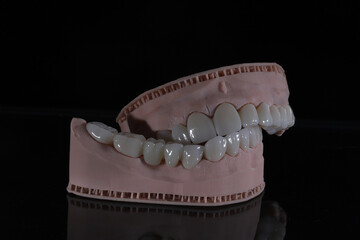 3D-printed jaw model and full-mouth zirconium porcelain crowns. Computer-assisted smile design treatment. dental before after.  © UniqDream