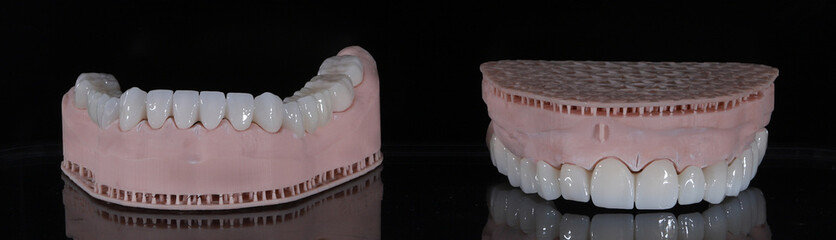3D-printed jaw model and full-mouth zirconium porcelain crowns. Computer-assisted smile design treatment. dental before after.  © UniqDream