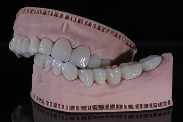 3D-printed jaw model and full-mouth zirconium porcelain crowns. Computer-assisted smile design treatment. dental before after.  © UniqDream