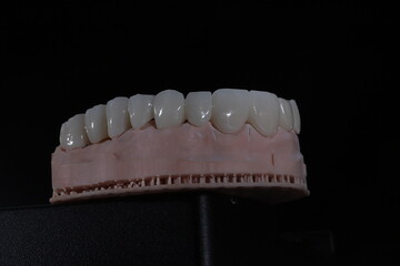 3D-printed jaw model and full-mouth zirconium porcelain crowns. Computer-assisted smile design treatment. dental before after.  © UniqDream
