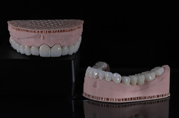 3D-printed jaw model and full-mouth zirconium porcelain crowns. Computer-assisted smile design treatment. dental before after.  © UniqDream