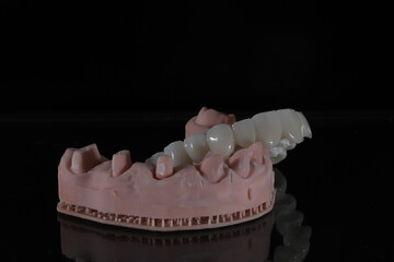 3D-printed jaw model and full-mouth zirconium porcelain crowns. Computer-assisted smile design treatment. dental before after.  © UniqDream