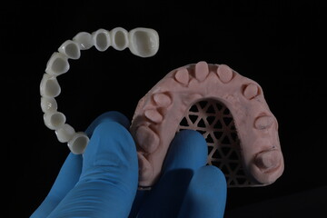 3D-printed jaw model and full-mouth zirconium porcelain crowns. Computer-assisted smile design treatment. dental before after.  © UniqDream