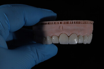 3D-printed jaw model and full-mouth zirconium porcelain crowns. Computer-assisted smile design treatment. dental before after.  © UniqDream