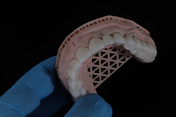 3D-printed jaw model and full-mouth zirconium porcelain crowns. Computer-assisted smile design treatment. dental before after.  © UniqDream