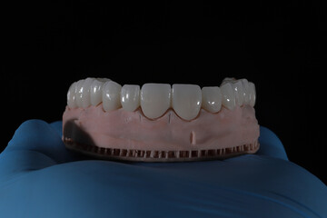 3D-printed jaw model and full-mouth zirconium porcelain crowns. Computer-assisted smile design treatment. dental before after.  © UniqDream
