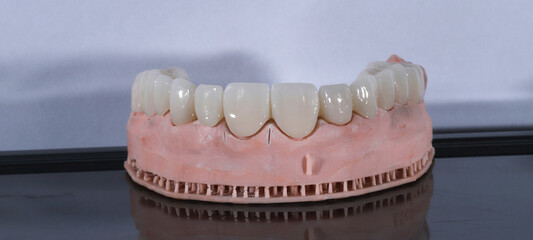 3D-printed jaw model and full-mouth zirconium porcelain crowns. Computer-assisted smile design treatment. dental before after.  © UniqDream