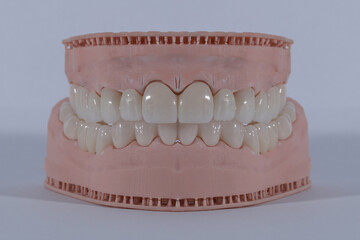 3D-printed jaw model and full-mouth zirconium porcelain crowns. Computer-assisted smile design treatment. dental before after.  © UniqDream