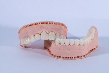 3D-printed jaw model and full-mouth zirconium porcelain crowns. Computer-assisted smile design treatment. dental before after.  © UniqDream