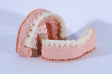 3D-printed jaw model and full-mouth zirconium porcelain crowns. Computer-assisted smile design treatment. dental before after.  © UniqDream