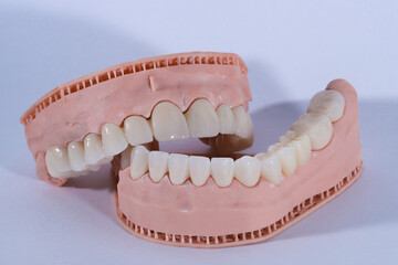 3D-printed jaw model and full-mouth zirconium porcelain crowns. Computer-assisted smile design treatment. dental before after.  © UniqDream