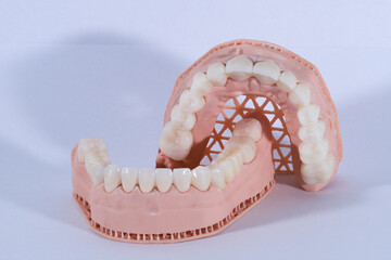 3D-printed jaw model and full-mouth zirconium porcelain crowns. Computer-assisted smile design treatment. dental before after.  © UniqDream