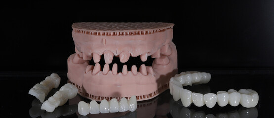 Dental zirconium porcelain crowns placed on a digital model. Aesthetic visual with dental smile design. © UniqDream