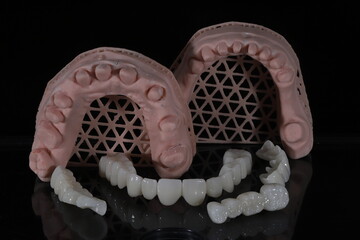 Dental zirconium porcelain crowns placed on a digital model. Aesthetic visual with dental smile design. © UniqDream