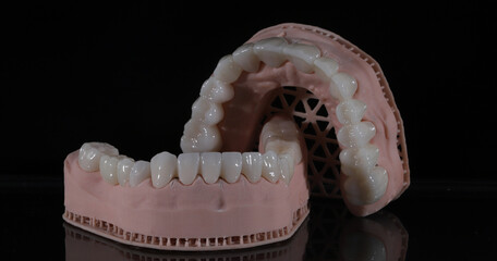Dental zirconium porcelain crowns placed on a digital model. Aesthetic visual with dental smile design. © UniqDream