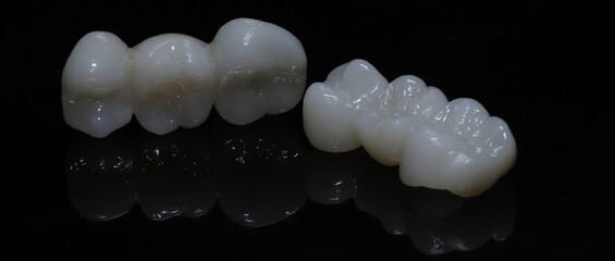 Bridge crown prosthesis treatment in dental aesthetic dentistry for missing teeth. Zirconium porcelain bridge treatment and E-max porcelain tooth coating. © UniqDream