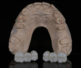 Bridge crown prosthesis treatment in dental aesthetic dentistry for missing teeth. Zirconium porcelain bridge treatment and E-max porcelain tooth coating. © UniqDream