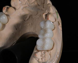 Bridge crown prosthesis treatment in dental aesthetic dentistry for missing teeth. Zirconium porcelain bridge treatment and E-max porcelain tooth coating. © UniqDream