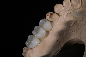 Bridge crown prosthesis treatment in dental aesthetic dentistry for missing teeth. Zirconium porcelain bridge treatment and E-max porcelain tooth coating. © UniqDream