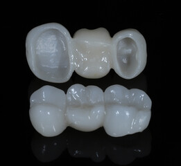 Bridge crown prosthesis treatment in dental aesthetic dentistry for missing teeth. Zirconium...