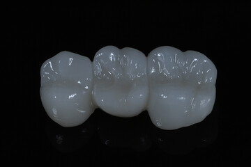 Bridge crown prosthesis treatment in dental aesthetic dentistry for missing teeth. Zirconium porcelain bridge treatment and E-max porcelain tooth coating. © UniqDream