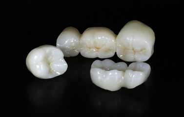 Bridge crown prosthesis treatment in dental aesthetic dentistry for missing teeth. Zirconium porcelain bridge treatment and E-max porcelain tooth coating. © UniqDream