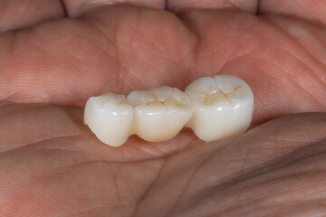 Bridge crown prosthesis treatment in dental aesthetic dentistry for missing teeth. Zirconium porcelain bridge treatment and E-max porcelain tooth coating. © UniqDream