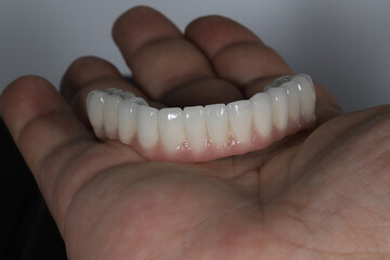 Full-arch porcelain implant-supported dental prosthesis for edentulous jaws with All-on-X and All-on-4 treatment procedure using dental implant surgery.