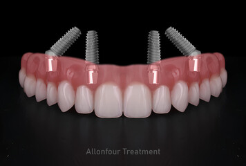 In dental implant surgery, the All-on-Four, All-on-4, and All-on-X treatments involve placing full-arch dental prostheses on cylindrical titanium implants applied to the upper jaw. Dental before after © UniqDream