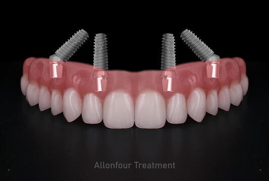 In dental implant surgery, the All-on-Four, All-on-4, and All-on-X treatments involve placing full-arch dental prostheses on cylindrical titanium implants applied to the upper jaw. Dental before after