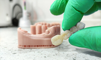 Bridge crown prosthesis treatment in dental aesthetic dentistry for missing teeth. Zirconium porcelain bridge treatment and E-max porcelain tooth coating. © UniqDream